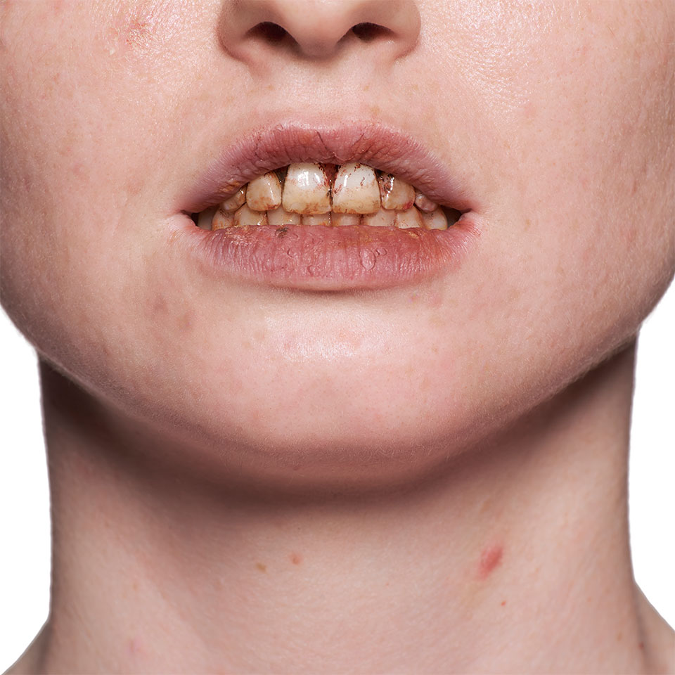 Tooth Enamel - Image 2