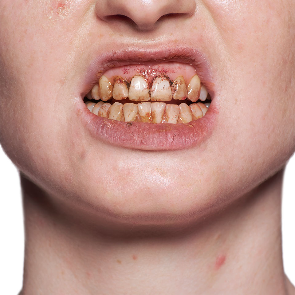 Tooth Enamel - Image 3